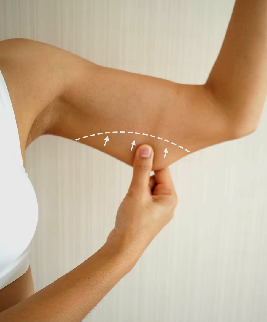 Arm Lift