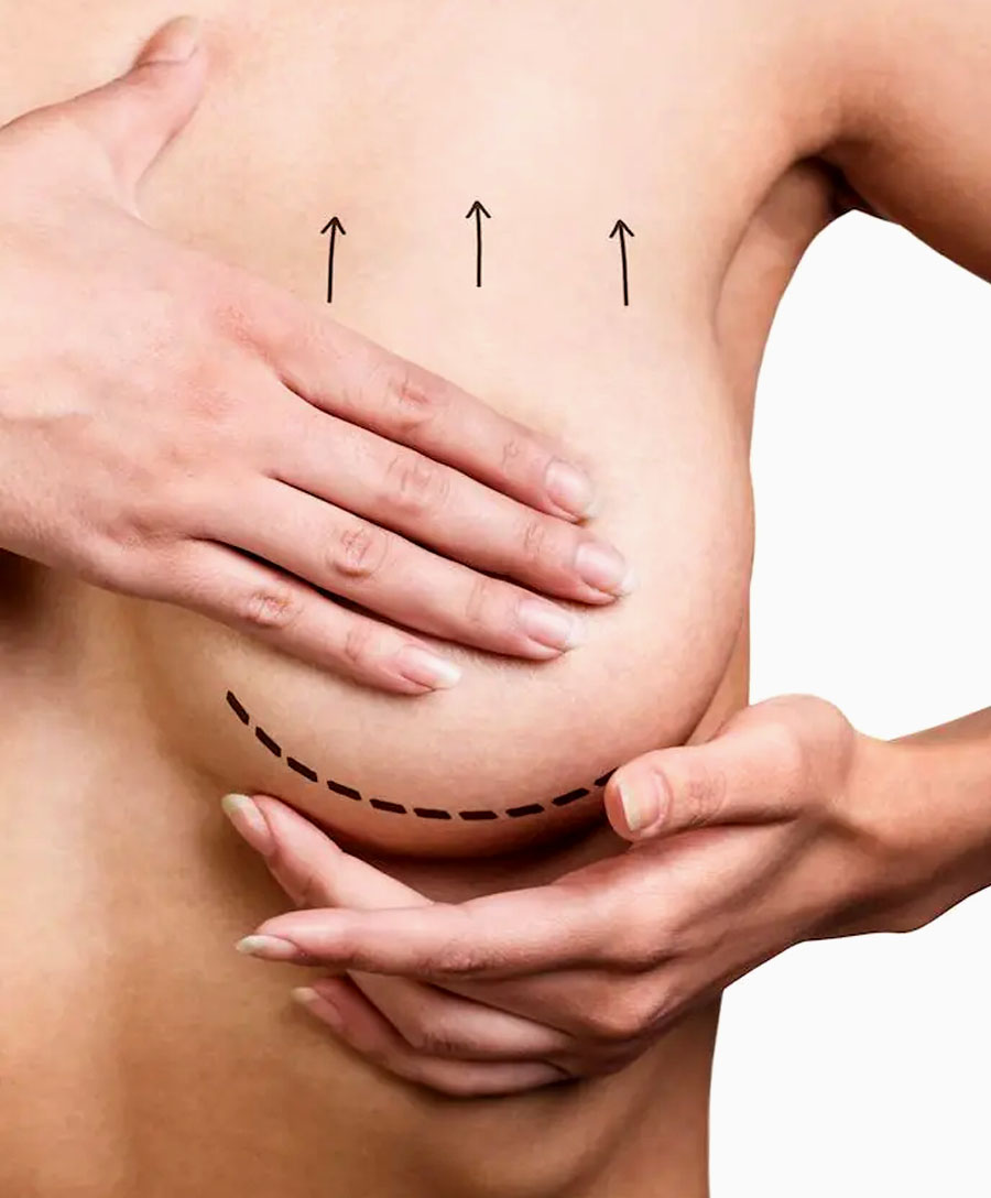 What is Breast Lift (Mastopexy)