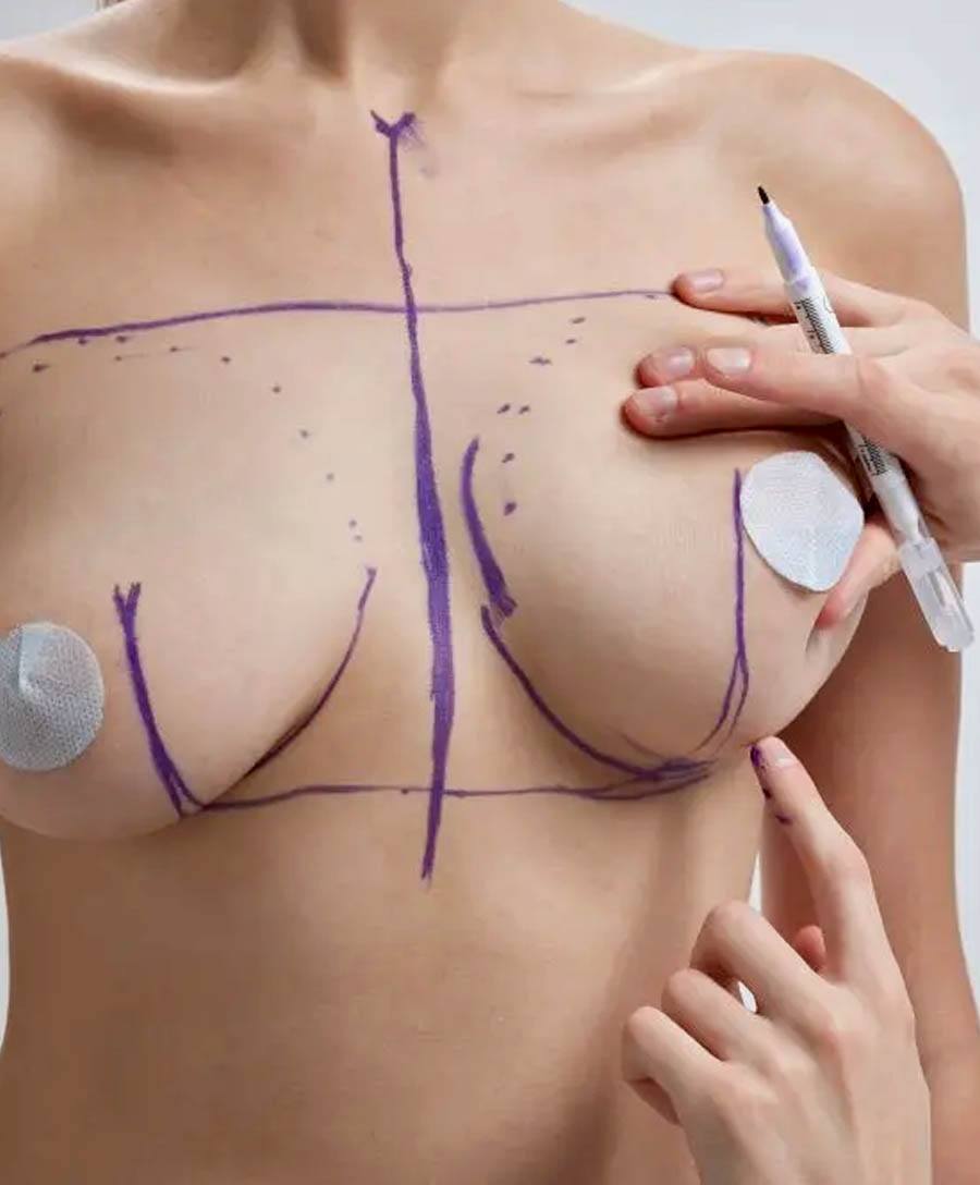 What is Breast Reduction