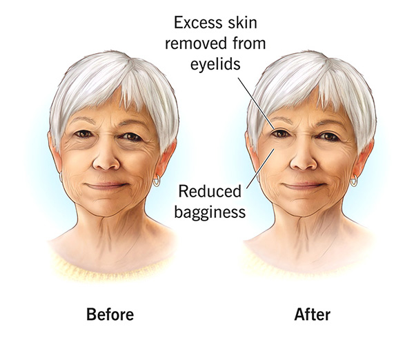 eyelid surgery