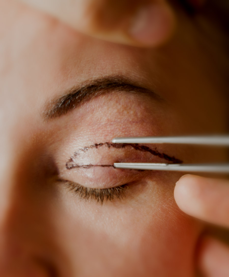 eyelid surgery