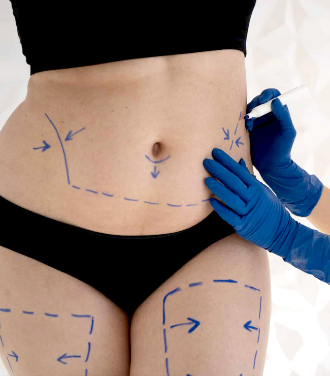 FEATURED Procedures - Liposuction