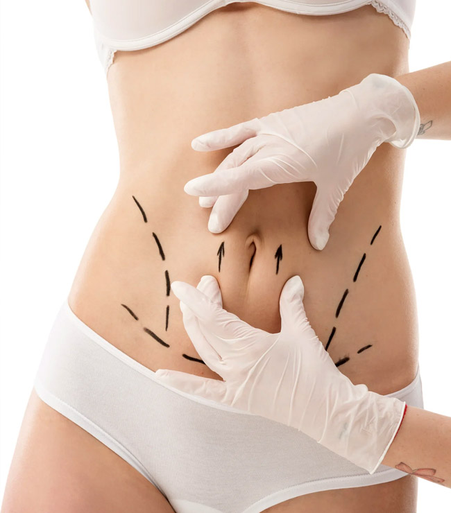 FEATURED Procedures - Tummy Tuck