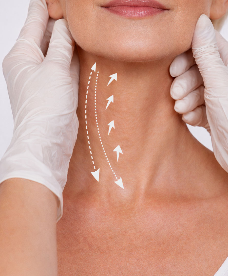 What is Neck lift?