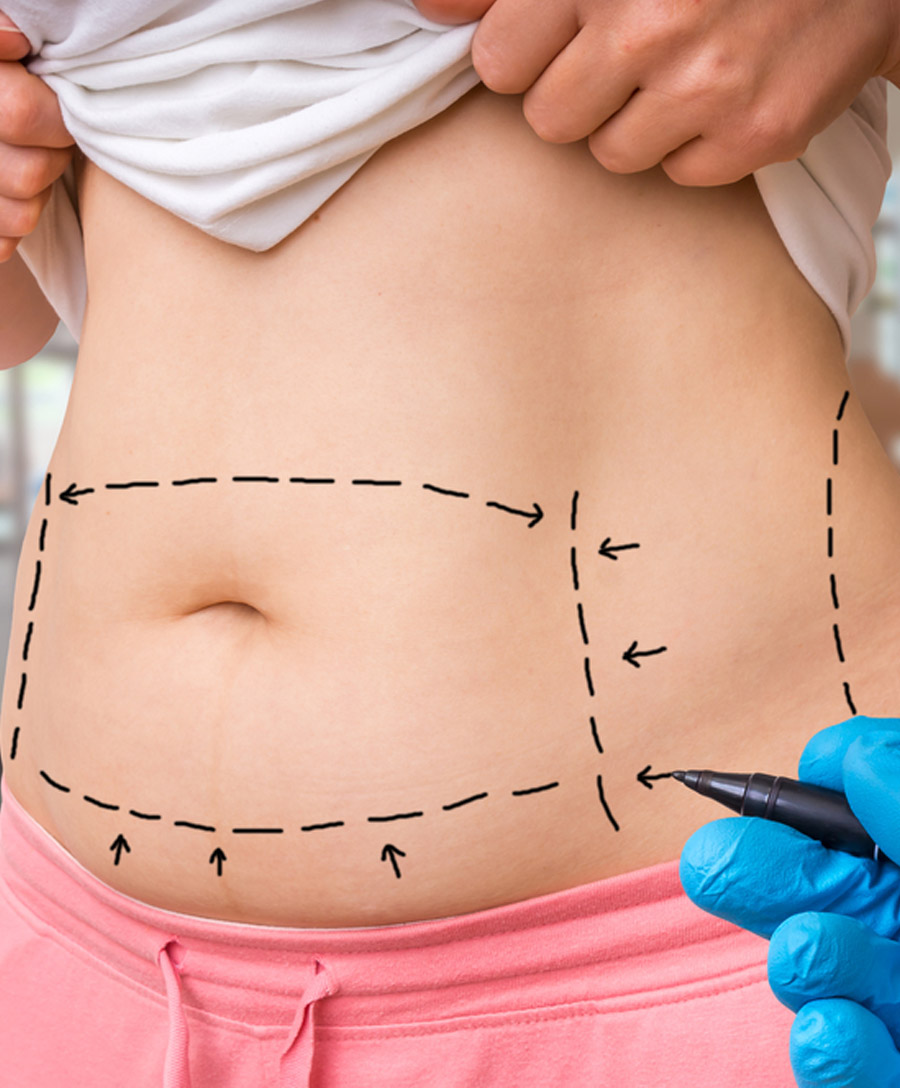What Is Liposuction?